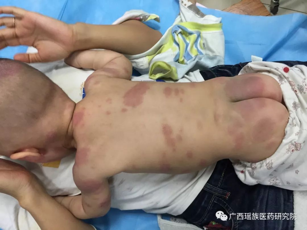 【立冬】皮肤病将进入高发季~