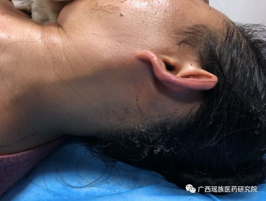瑶医三元火攻疗法治疗--煤气火焰轻度烧伤
